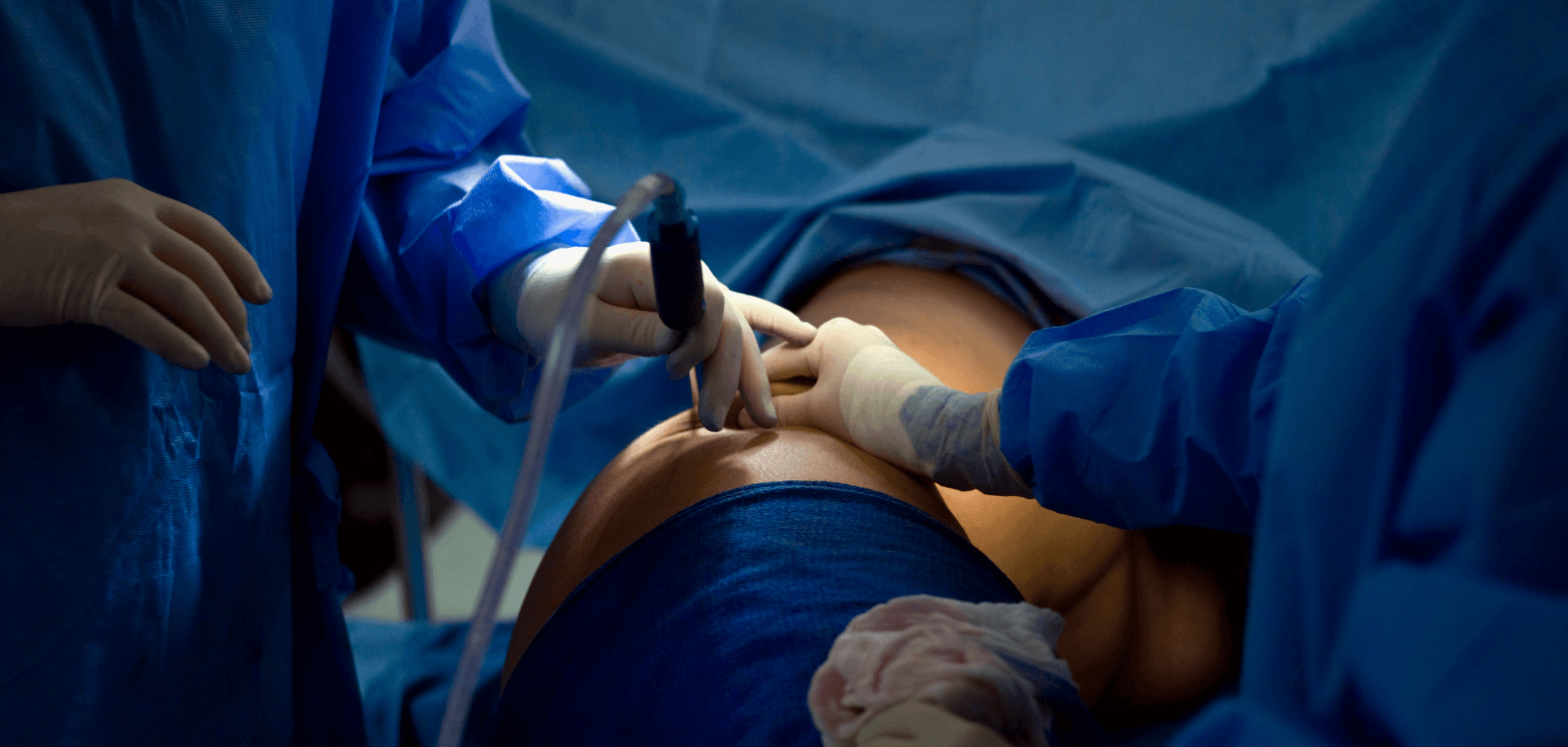 Exploring Alternatives to Liposuction Surgery